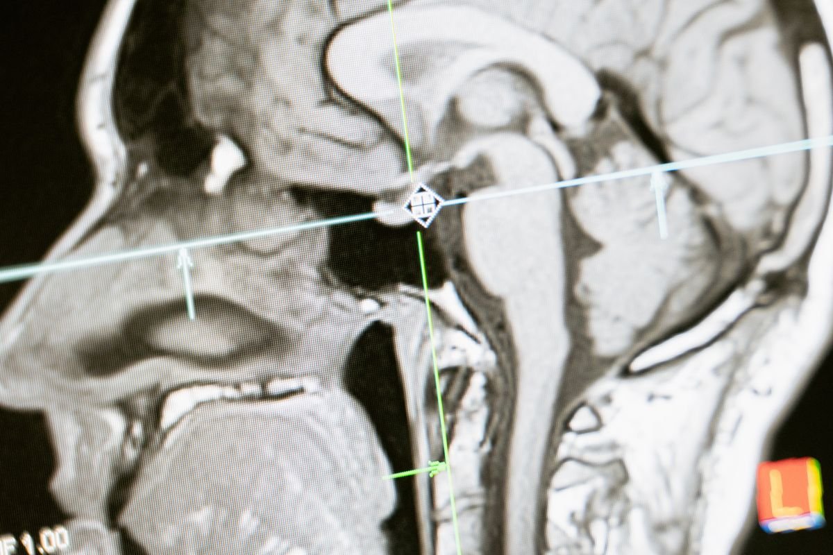 The Fearful Brain: Why the Amygdala Hijacks Your Decisions